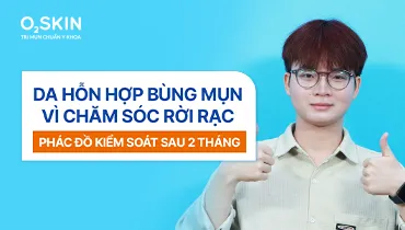 Da hỗn hợp bùng mụn vì chăm sóc rời rạc: Phác đồ kiểm soát sau 2 tháng