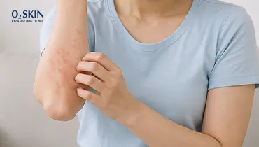 “Dị ứng thời tiết” là gì? Phân biệt với kích ứng da, mề đay và viêm da cơ địa